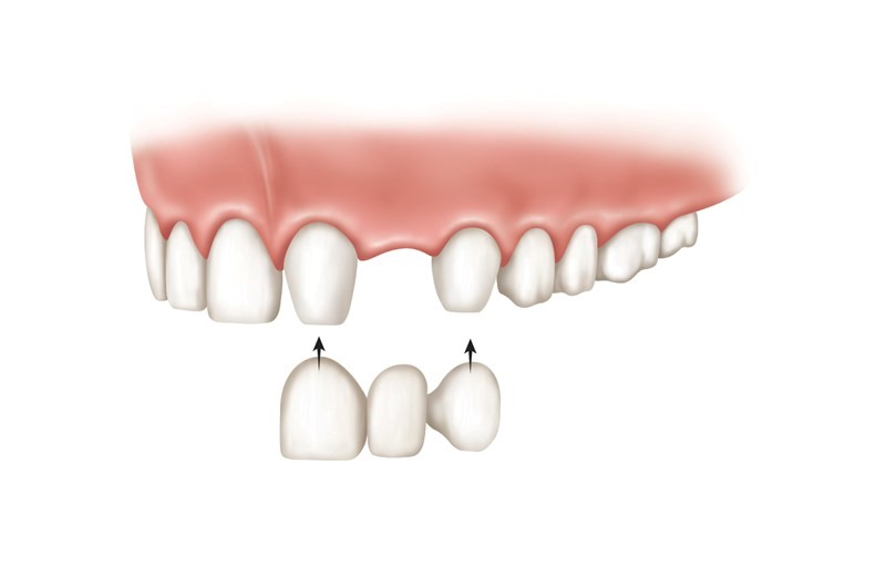 Immediate Dentures Procedure Cactus TX 79013